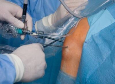 Knee being treated with Arthroscopic Surgery In PCMC Pune by orthopedic specialists