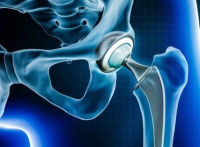 Digital illustration of Hip Replacement Surgery In PCMC Pune