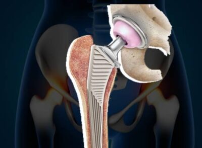 Hip implant model showing Revision Joint Replacement Surgery In PCMC Pune