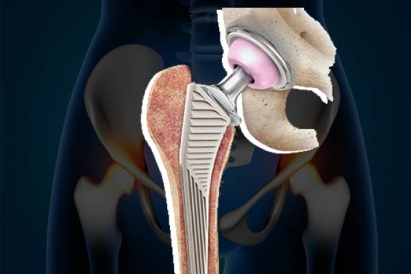 Hip implant model showing Revision Joint Replacement Surgery In PCMC Pune