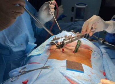 Spine Surgery in PCMC Pune being performed by expert orthopedic surgeons