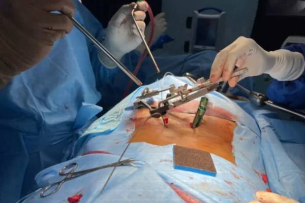 Spine Surgery in PCMC Pune being performed by expert orthopedic surgeons