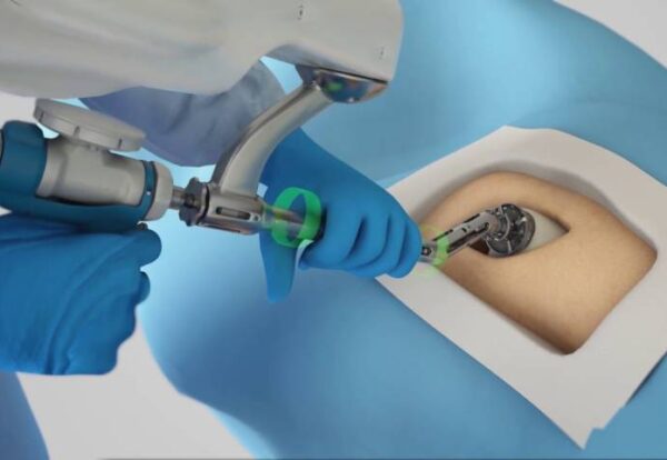 Robotic procedure showing the Latest Technologies in Hip Replacement Surgery by Dr. Ashutosh Jadhav in PCMC, Pune