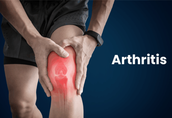 Person holding painful knee with inflammation – Does Arthritis Always Require Surgery