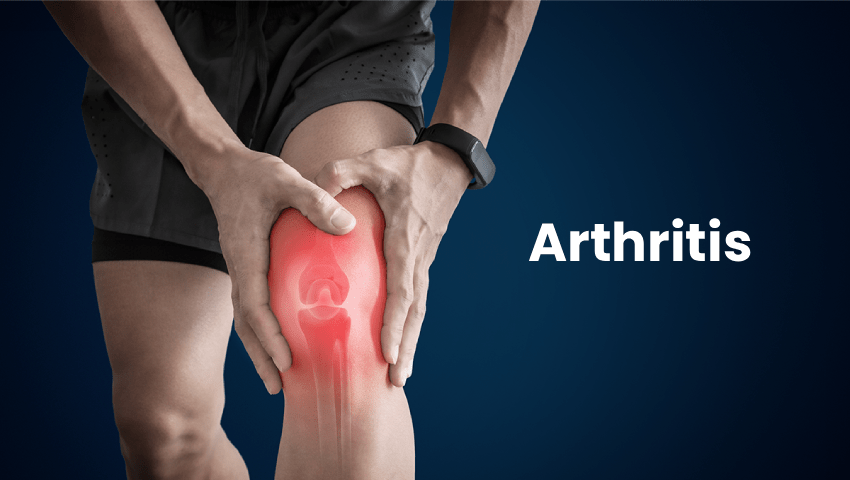 Person holding painful knee with inflammation – Does Arthritis Always Require Surgery