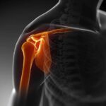 Top 5 Causes of Shoulder Dislocation You Should Know