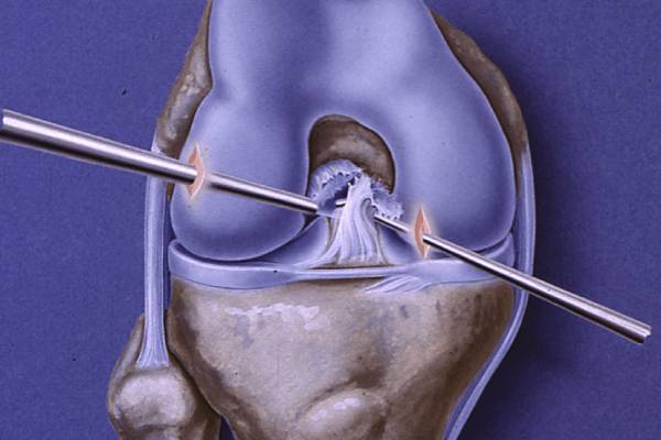 Illustration showing the surgical process of ACL Reconstruction Surgery in PCMC