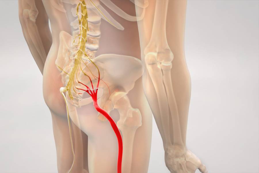 Sciatica Treatment in PCMC showing sciatica on left side with sciatic nerve pain and relief through proper treatment for sciatica pain