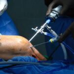 What Is Arthroscopic Knee Surgery? Procedure, Recovery & Results